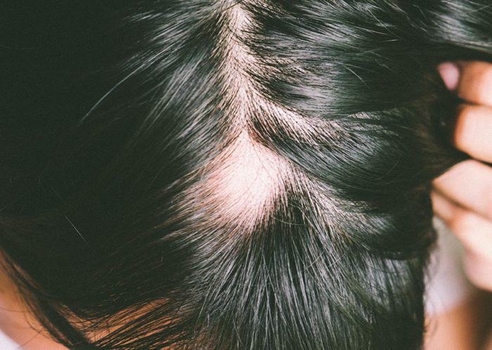 Alopecia Areata Cl Nica Ideal Dermatologia Capilar