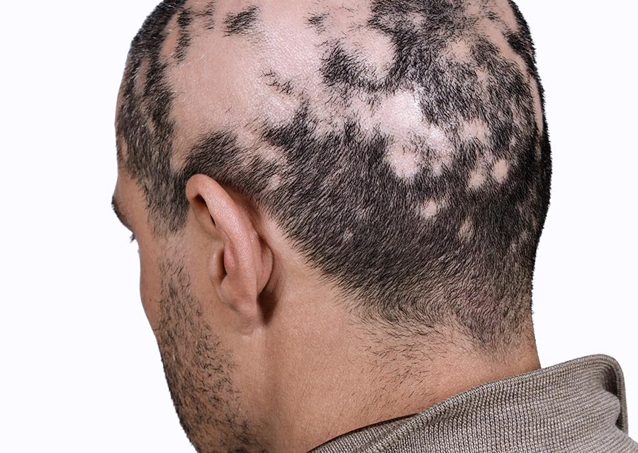 alopecia cicatricial