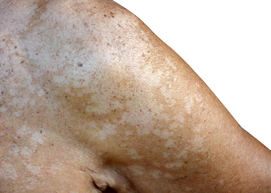 Micose: Causas e Sintomas - Dermatologia