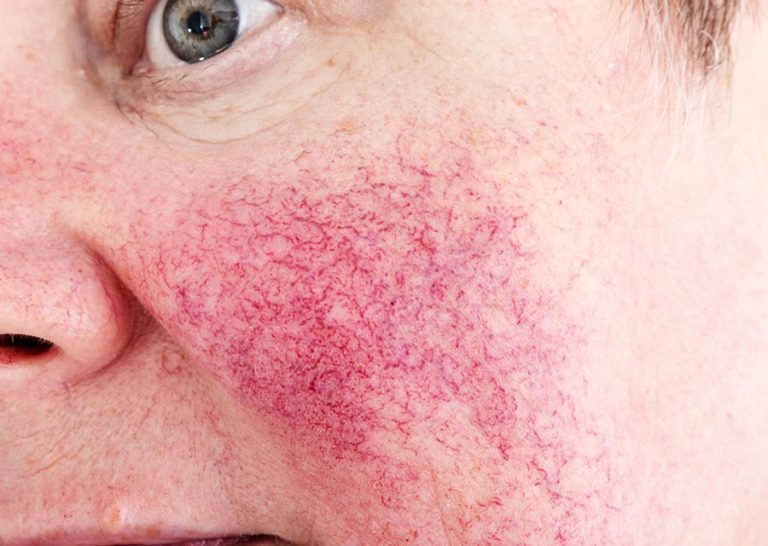 Rosácea Conheça Essa Doença Clínica Ideal Dermatologia Clínica